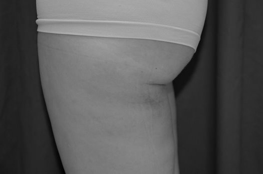 lateral left thigh 3 wks post op BW 1