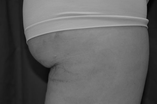 lateral right thigh 3 wks post op BW 1