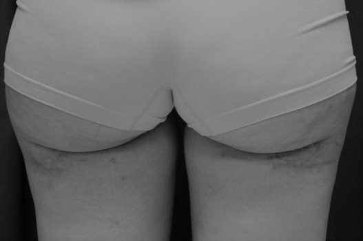 posterior upper thigh 3 wks post op BW 1