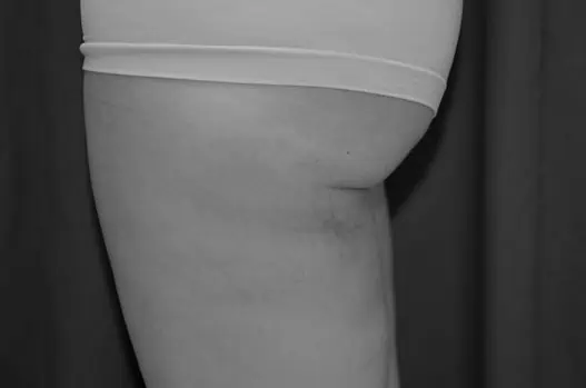 lateral left thigh 3 wks post op BW 1